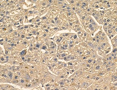 Tensin-2 Antibody - DF8623 at 1/100 staining human mammary cancer and para-carcinoma tissue by IHC-P.
