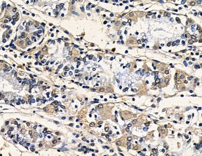 Trypsin-3 Antibody - DF8625 at 1/100 staining human pancreatic cancer and para-carcinoma tissue by IHC-P.