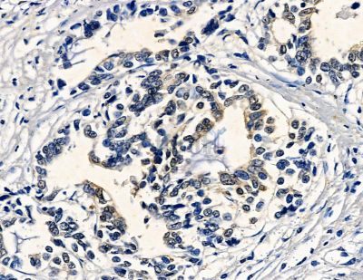 Trypsin-3 Antibody - DF8625 at 1/100 staining human pancreatic cancer by IHC-P.