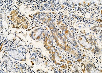 AIFM2 Antibody - DF8636 at 1/100 staining human gastric cancer by IHC-P.