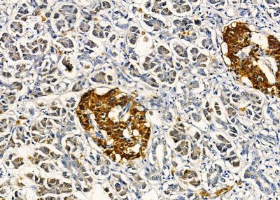 AIFM2 Antibody - DF8636 at 1/100 staining human pancreatic cancer by IHC-P.