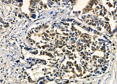 ZNF7 Antibody - DF8791 at 1/100 staining human gastric cancer by IHC-P.