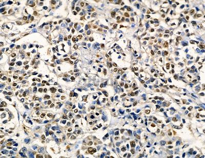 ZNF7 Antibody - DF8791 at 1/100 staining human colorectal cancer by IHC-P.