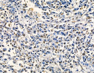 ZNF7 Antibody - DF8791 at 1/100 staining human prostate cancer by IHC-P.