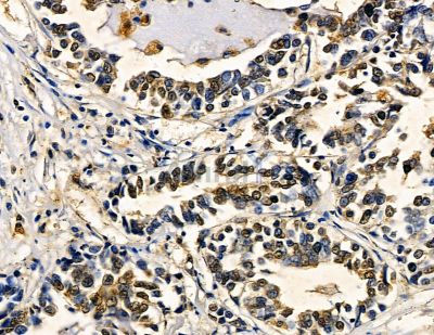 ZNF7 Antibody - DF8791 at 1/100 staining human pancreatic cancer by IHC-P.