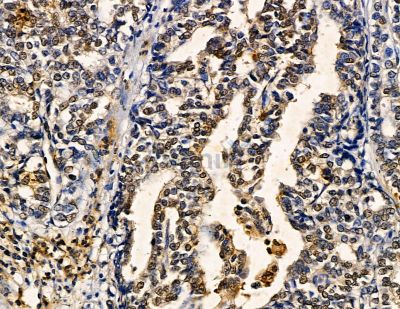 ZNF7 Antibody - DF8791 at 1/100 staining human pancreatic cancer by IHC-P.