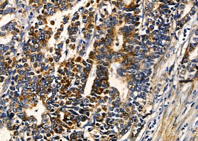 TPD52L3 Antibody - DF8860 at 1/100 staining human gastric cancer by IHC-P.