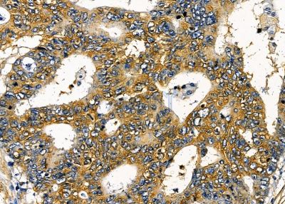 ILRL2 Antibody - DF8987 at 1/100 staining human liver cancer by IHC-P.