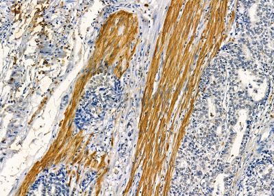 MAGF1 Antibody - DF9020 at 1/100 staining human gastric cancer by IHC-P.