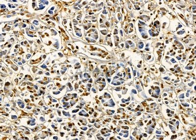 NFAM1 Antibody - DF9026 at 1/100 staining human pancreatic cancer by IHC-P.