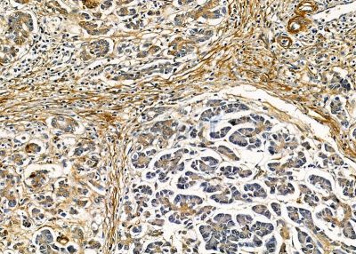 TUBE1 Antibody - DF9034 at 1/100 staining human pancreatic cancer by IHC-P.