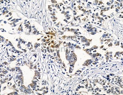 MAF1 Antibody - DF9079 at 1/100 staining human gastric cancer by IHC-P.
