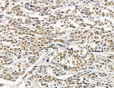 MAF1 Antibody - DF9079 at 1/100 staining human prostate cancer by IHC-P.