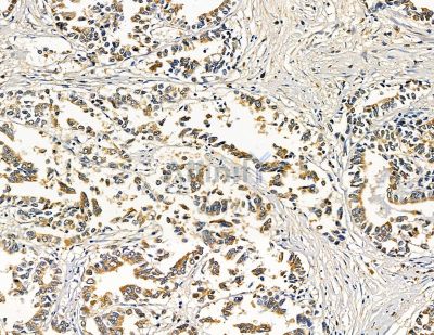 ABHD10 Antibody - DF9141 at 1/100 staining human gastric cancer by IHC-P.