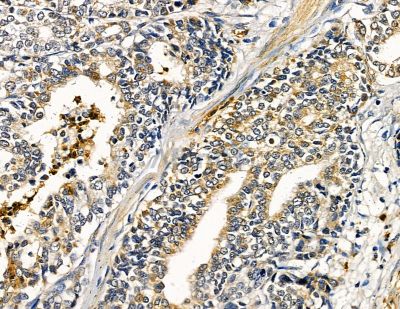 ABHD10 Antibody - DF9141 at 1/100 staining human pancreatic cancer by IHC-P.