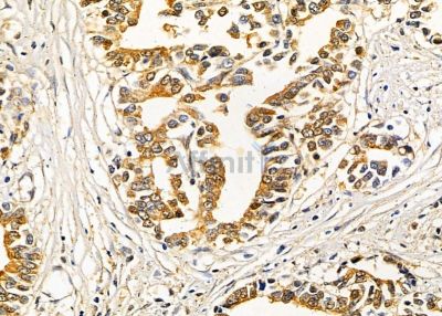 ANGPTL5 Antibody - DF9211 at 1/100 staining human gastric cancer by IHC-P.