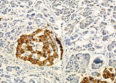 CGRRF1 Antibody - DF9357 at 1/100 staining human pancreatic cancer by IHC-P.