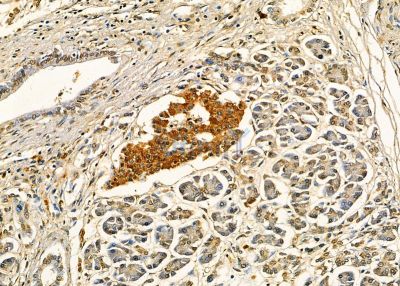 EDEM2 Antibody - DF9503 at 1/100 staining human pancreatic cancer by IHC-P.