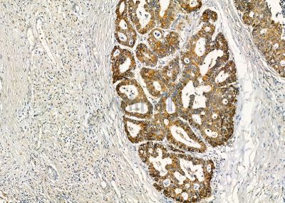 LILRB2 Antibody - DF9604 at 1/100 staining human prostate cancer and para-carcinoma tissue by IHC-P.