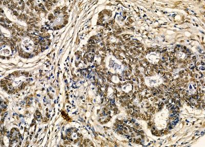 NGRN Antibody - DF9680 at 1/100 staining human liver cancer by IHC-P.
