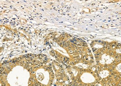 RASA4 Antibody - DF9805 at 1/100 staining human prostate cancer and para-carcinoma tissue by IHC-P.