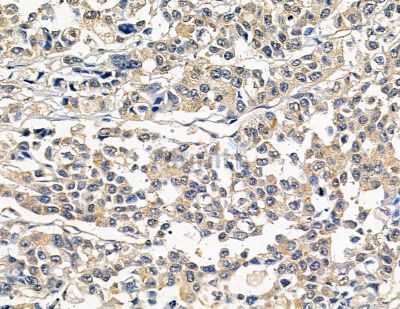 RERG Antibody - DF9811 at 1/100 staining human prostate cancer by IHC-P.