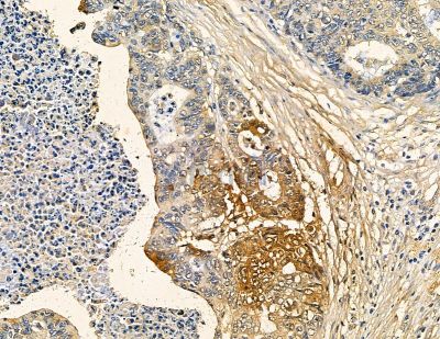 RFPL4B Antibody - DF9851 at 1/100 staining human prostate cancer and para-carcinoma tissue by IHC-P.
