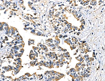 RPAP3 Antibody - DF9875 at 1/100 staining human gastric cancer by IHC-P.
