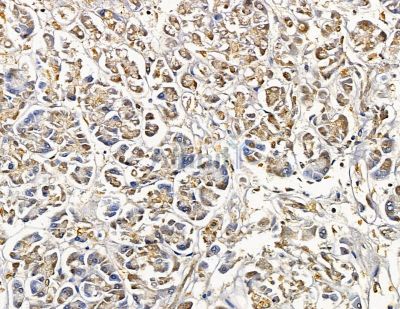 STK25 Antibody - DF9883 at 1/100 staining human pancreatic cancer by IHC-P.