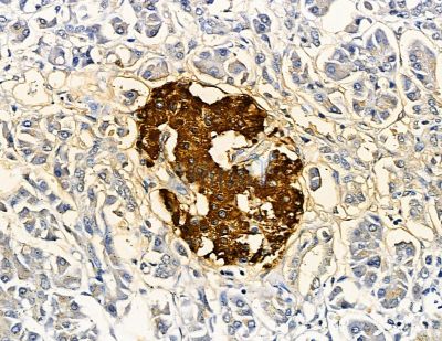 SLC10A4 Antibody - DF9931 at 1/100 staining human pancreatic cancer by IHC-P.