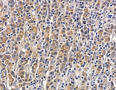 Calpastatin Antibody - DF13778 at 1/100 staining human gastric cancer by IHC-P.