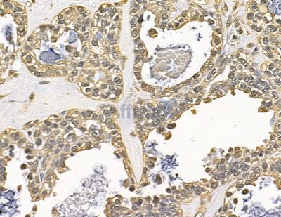 RNF8 Antibody - DF13868 at 1/100 staining human ovarian cancer by IHC-P.
