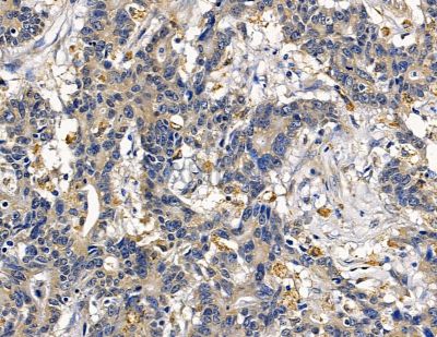 TMEM126A Antibody - DF13916 at 1/100 staining human colorectal cancer by IHC-P.