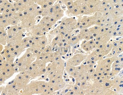 RBP1 Antibody - DF13925 at 1/100 staining human liver cancer by IHC-P.