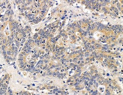 TTPA Antibody - DF13928 at 1/100 staining human colorectal cancer by IHC-P.