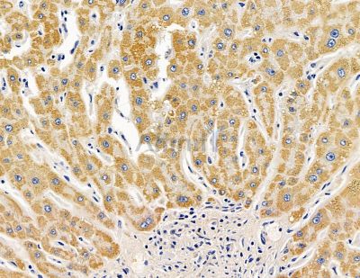 TTPA Antibody - DF13928 at 1/100 staining human liver cancer by IHC-P.