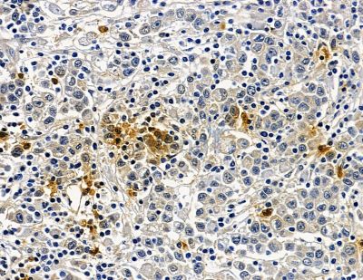 IRX3 Antibody - DF13946 at 1/100 staining human gastric cancer by IHC-P.