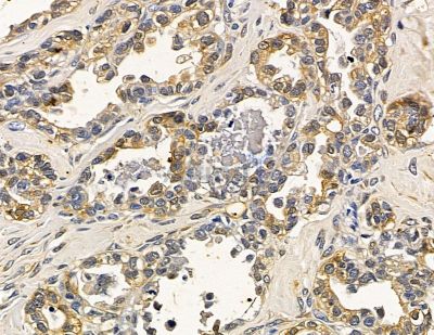 RNF135 Antibody - DF13982 at 1/100 staining human ovarian cancer by IHC-P.