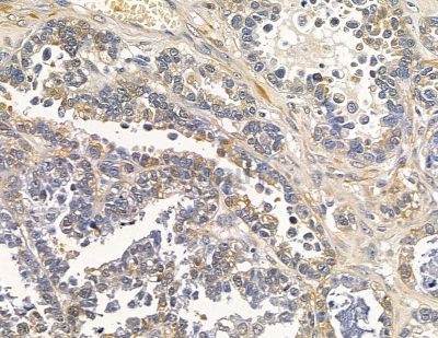 COQ10B Antibody - DF13998 at 1/100 staining human ovarian cancer by IHC-P.