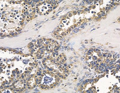 CHRNB2 Antibody - DF14019 at 1/100 staining human ovarian cancer by IHC-P.