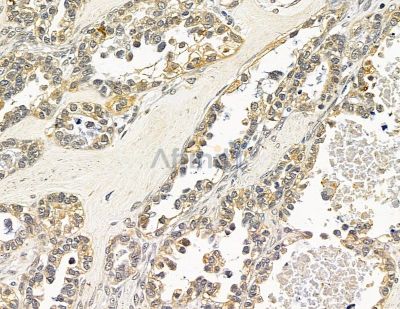 NOS1AP Antibody - DF14807 at 1/100 staining human ovarian cancer by IHC-P.