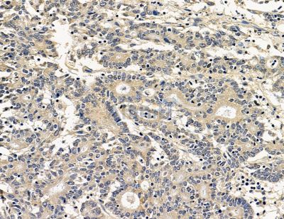 JCHAIN Antibody - DF14810 at 1/100 staining human prostate cancer by IHC-P.
