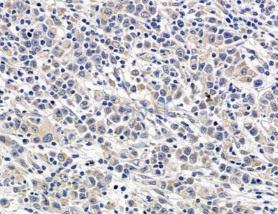 RNASE1 Antibody - DF14814 at 1/100 staining human gastric cancer by IHC-P.
