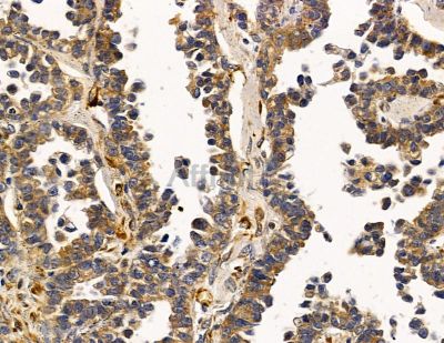 DSC2 Antibody - DF14823 at 1/100 staining human ovarian cancer by IHC-P.