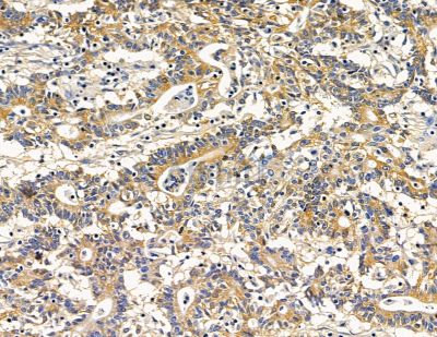 RASGRP4 Antibody - DF14835 at 1/100 staining human prostate cancer by IHC-P.