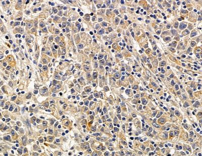 SMR3A Antibody - DF14880 at 1/100 staining human gastric cancer by IHC-P.