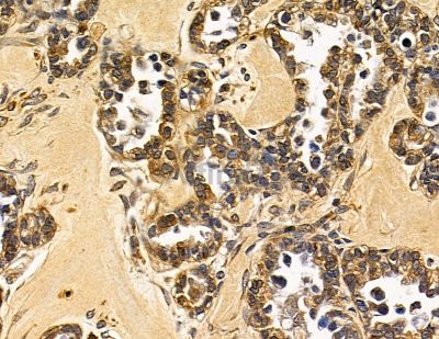 TONSL Antibody - DF14906 at 1/100 staining human ovarian cancer by IHC-P.