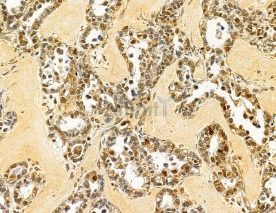 DPH1 Antibody - DF14907 at 1/100 staining human ovarian cancer by IHC-P.