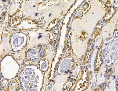 PPP1R18 Antibody - DF14927 at 1/100 staining human ovarian cancer by IHC-P.