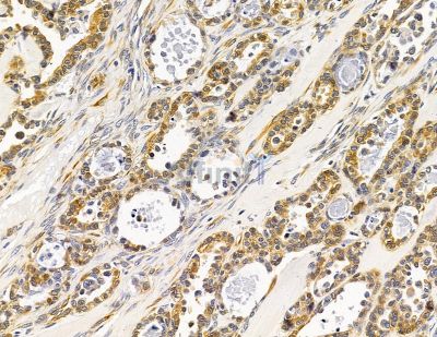 WDR73 Antibody - DF14942 at 1/100 staining human ovarian cancer by IHC-P.